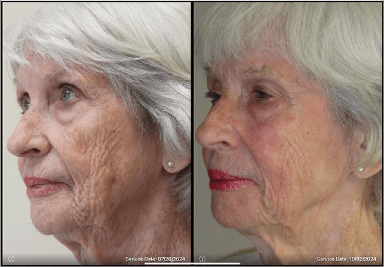 72 year old woman - UltraClear-Center-for-Aesthetics-beforeafter-2 72 year old woman - UltraClear-Center-for-Aesthetics-beforeafter-2