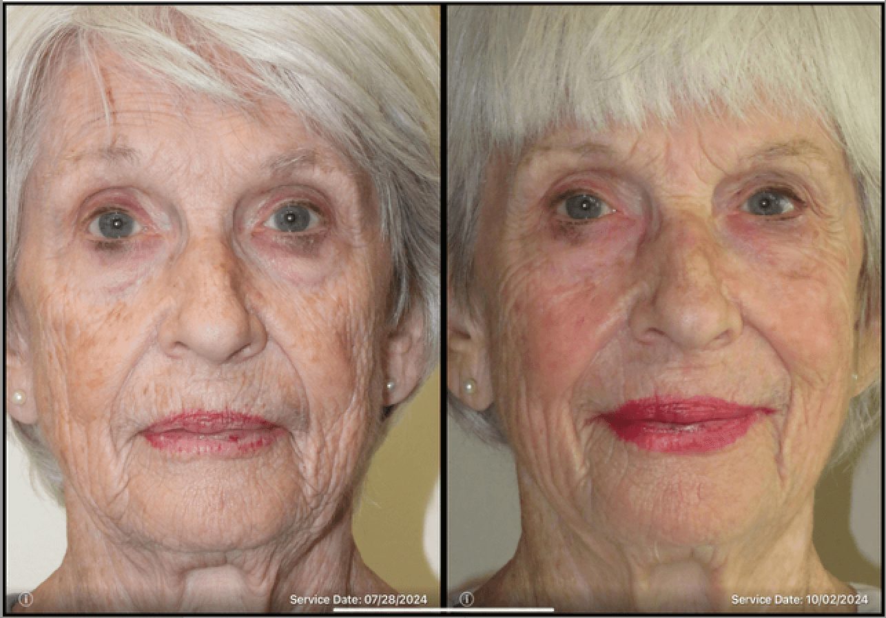 72 year old woman - UltraClear-Center-for-Aesthetics-beforeafter-3 72 year old woman - UltraClear-Center-for-Aesthetics-beforeafter-1