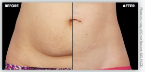 stomach before-after | CoolSculpting before and after photos -The Center for Aesthetics, CFA