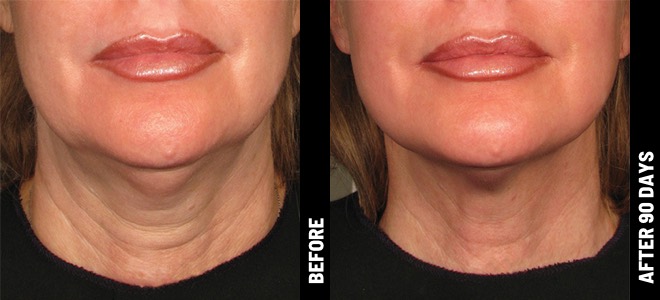 before-after ultherapy neck