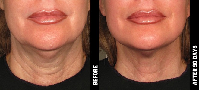 ultherapy-before-after-woman-idaho-falls-cfa