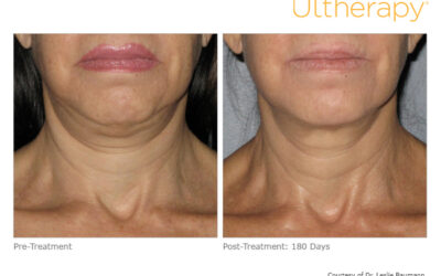 Yes, Ultherapy in Idaho Falls! A Powerful Non-Surgical Lift for Jowls, Double Chins & More